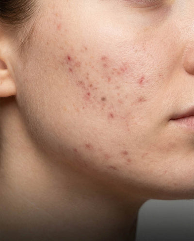 Cicatrici da acne