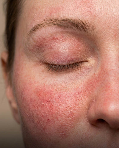 Pelle tendente alla rosacea